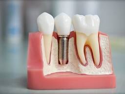 Стоматология в Бресте - Здравея: имплантация зубов
